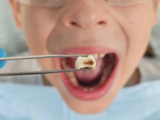 Best Chipped Tooth Repair Near Me  in Ocilla, GA